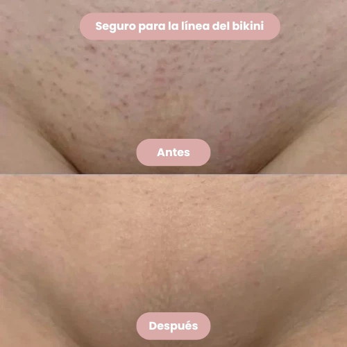 PURELAX™ -¡Olvídate de los molestos puntos rojos!