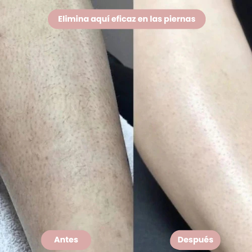 PURELAX™ -¡Olvídate de los molestos puntos rojos!